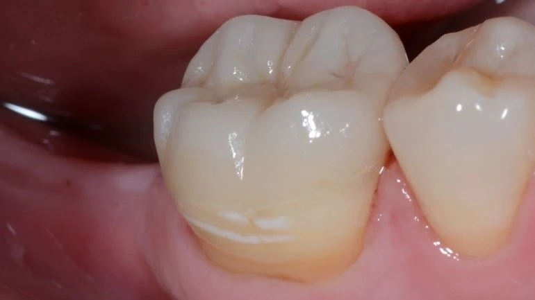 Zirconia keramische vormmethode