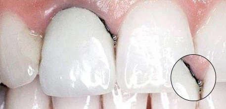 PFM dental crowns PFM dental crowns